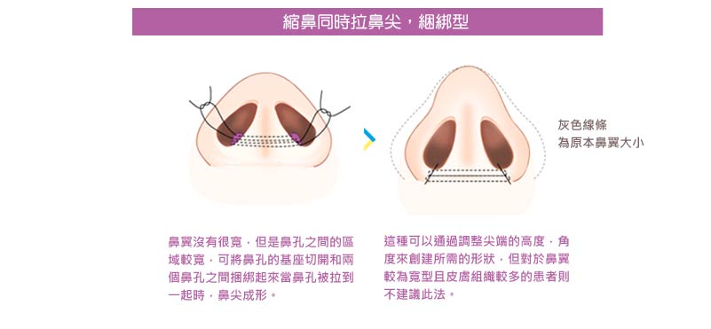 鼻形雕塑_韓式隆鼻_隆鼻推薦_縮鼻頭推薦_縮鼻翼_山根整形_隆鼻重修推薦__恆麗美型_蔡家碩_隆鼻失敗_隆鼻ptt_2017_04