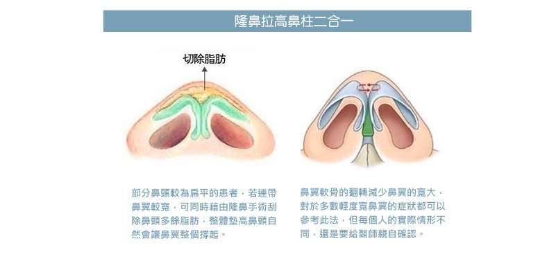 鼻形雕塑_韓式隆鼻_隆鼻推薦_縮鼻頭推薦_縮鼻翼_山根整形_隆鼻重修推薦__恆麗美型_蔡家碩_隆鼻失敗_隆鼻ptt_2017_05