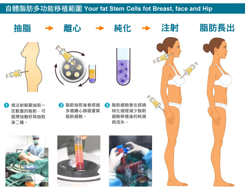 自體脂肪移植_總圖