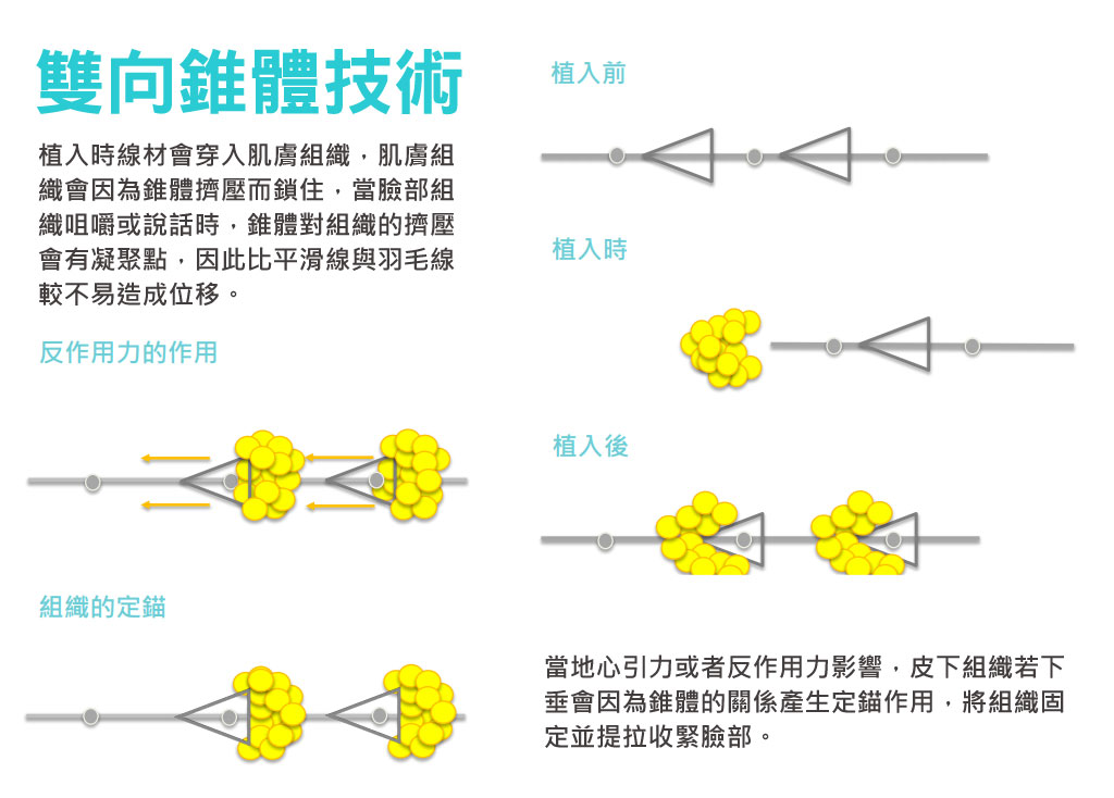 塑立愛立提線_少女線_少女線推薦_少女線價格_少女線效果_塑立愛原廠_少女線假貨_少女線拉皮_蔡家碩_恆麗美型_雙向椎體技術