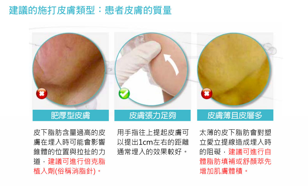 塑立愛立提線_少女線_雙向椎體技術_聚乳酸刺激膠原蛋白_塑立愛立提線活動