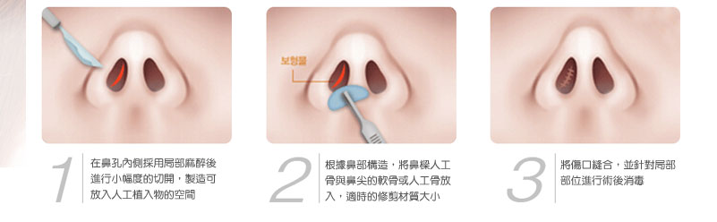 內開式隆鼻