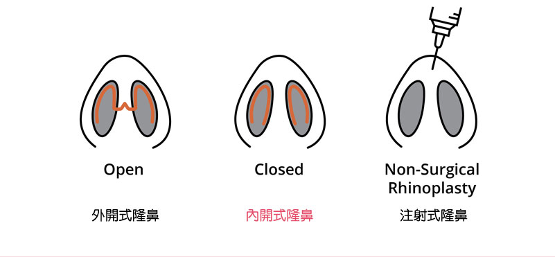 隆鼻種類