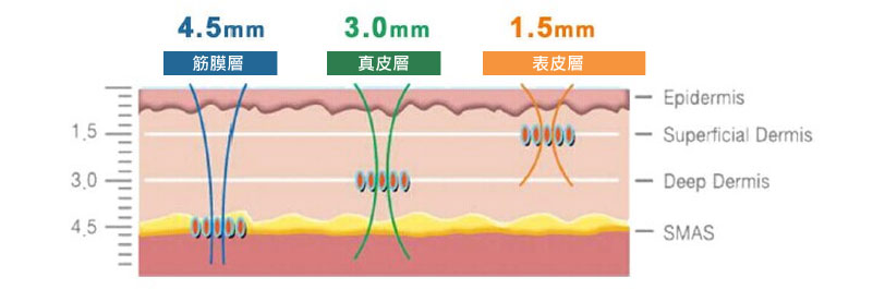 Ulthera音波拉提特色