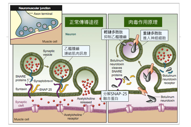 botox_ 肉毒桿菌原理