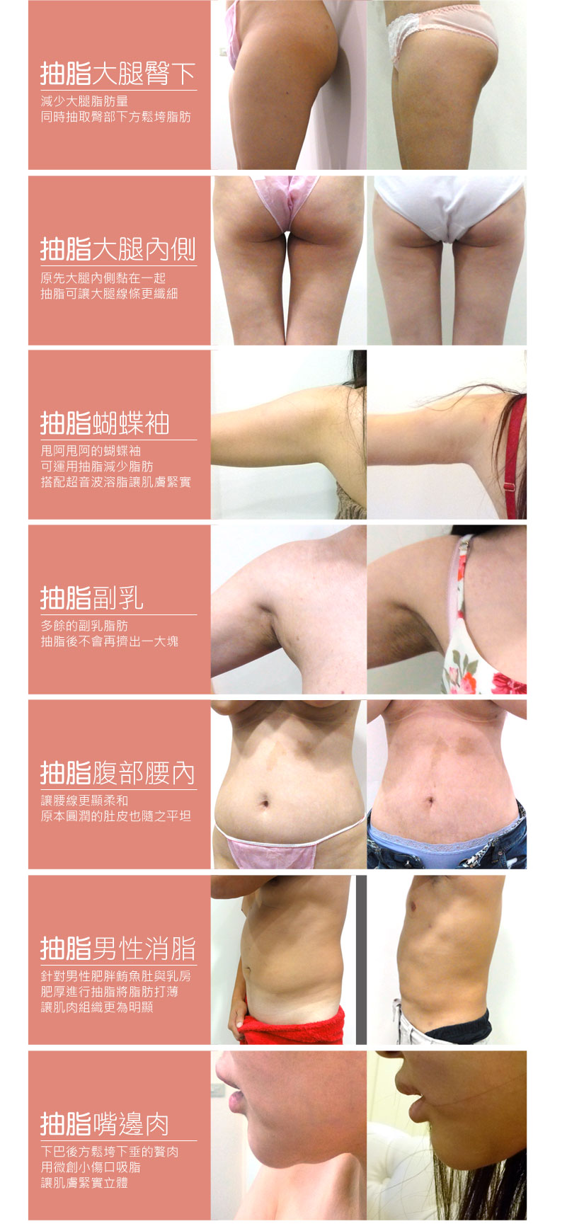 超音波溶脂 複合式抽脂 男女案例