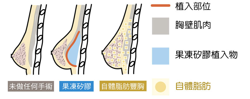 自體脂肪隆乳 果凍矽膠隆乳 差別