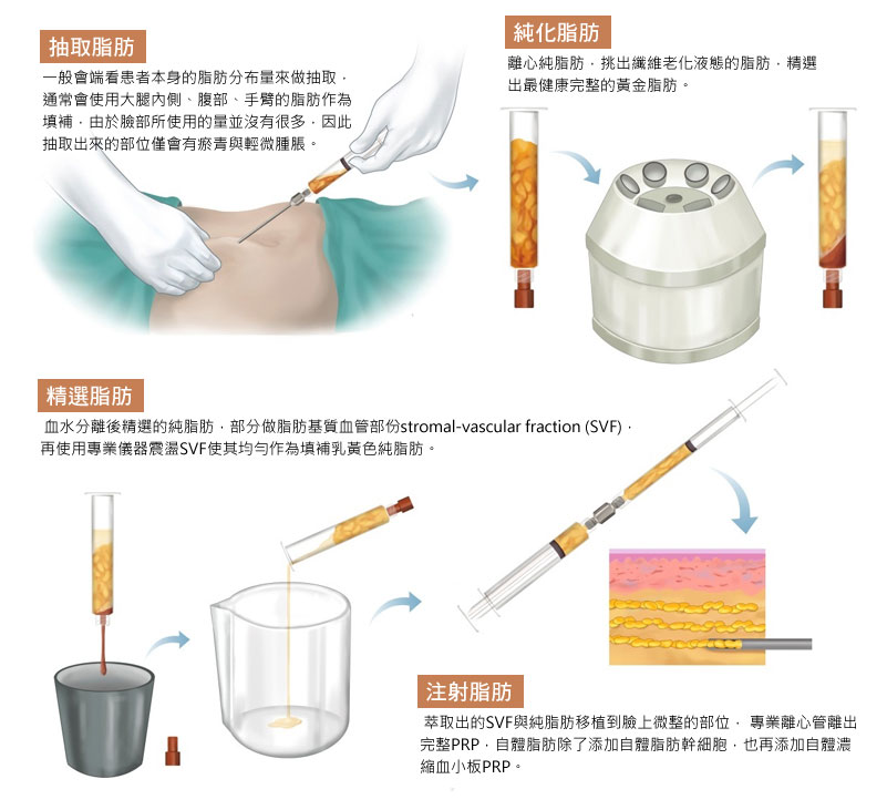 自體脂肪隆乳 脂肪純化 SVF 脂肪幹細胞 提升脂肪存活率