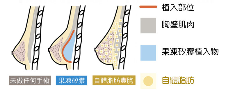 自體脂肪隆乳與果凍隆乳差別