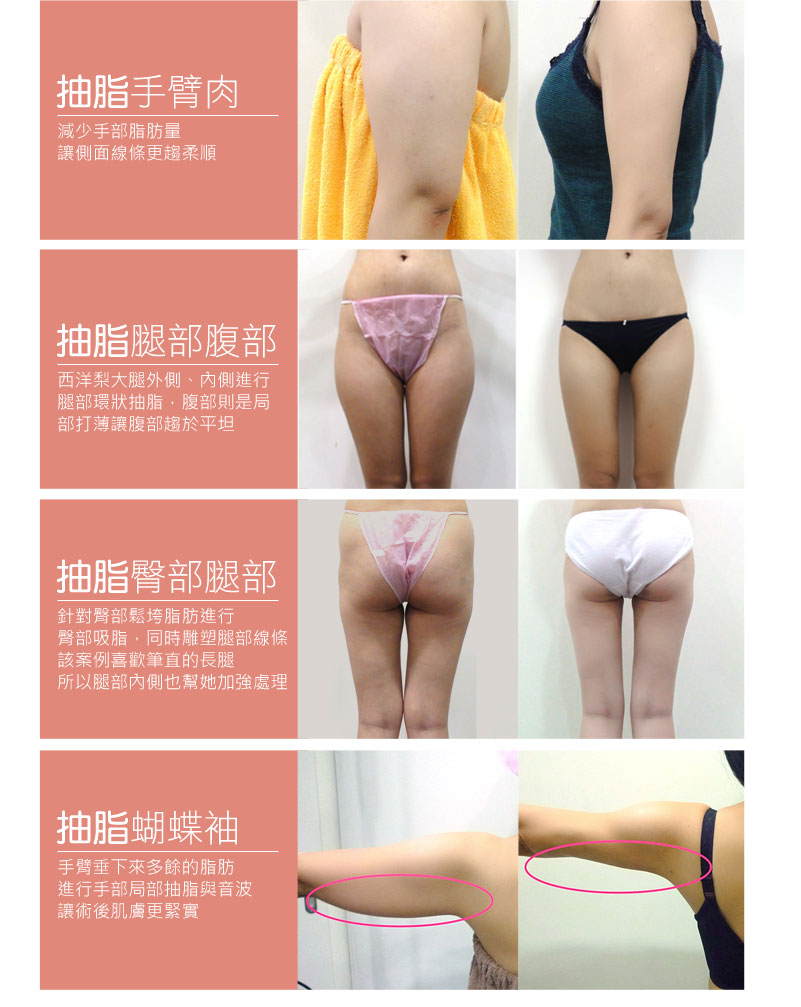 恆麗美型抽脂案例 蝴蝶袖 瘦手臂 瘦大腿