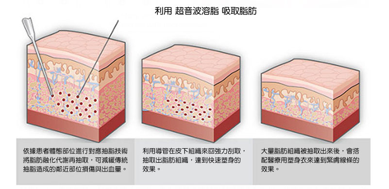 æ½èæè¡ æ°´å é³æ³¢ å³çµ±æ½è