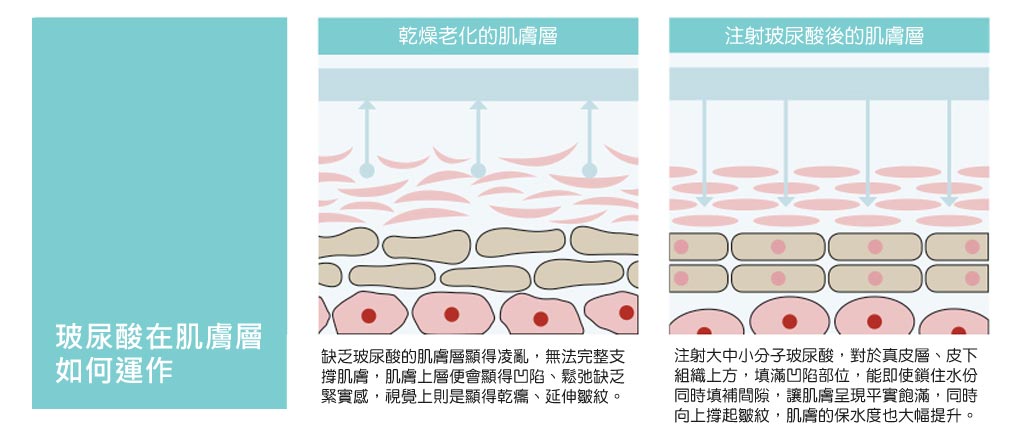 玻尿酸補充_04