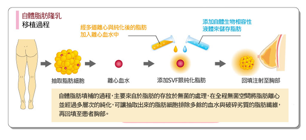 自體脂肪移植過程