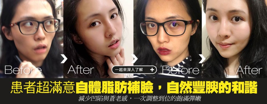 自體脂肪補臉，自然豐腴的和諧