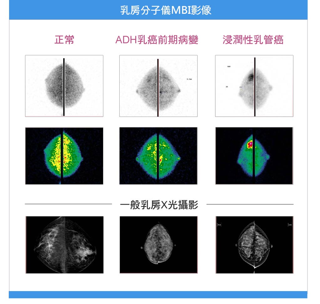 乳房分子影像(Molecular breast imaging , MBI