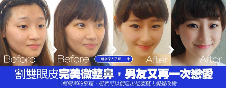 割雙眼皮+完美微整鼻