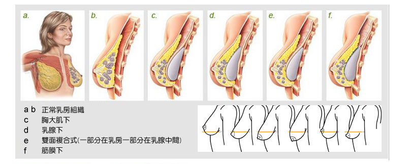 果凍矽膠隆乳_蜜絲絨_水滴_自體脂肪隆乳_豐胸_蔡家碩