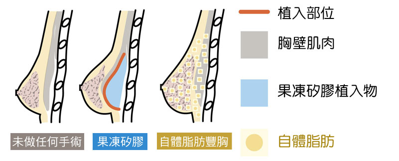 果凍矽膠隆乳_自體脂肪隆乳_優缺_副作用_失敗