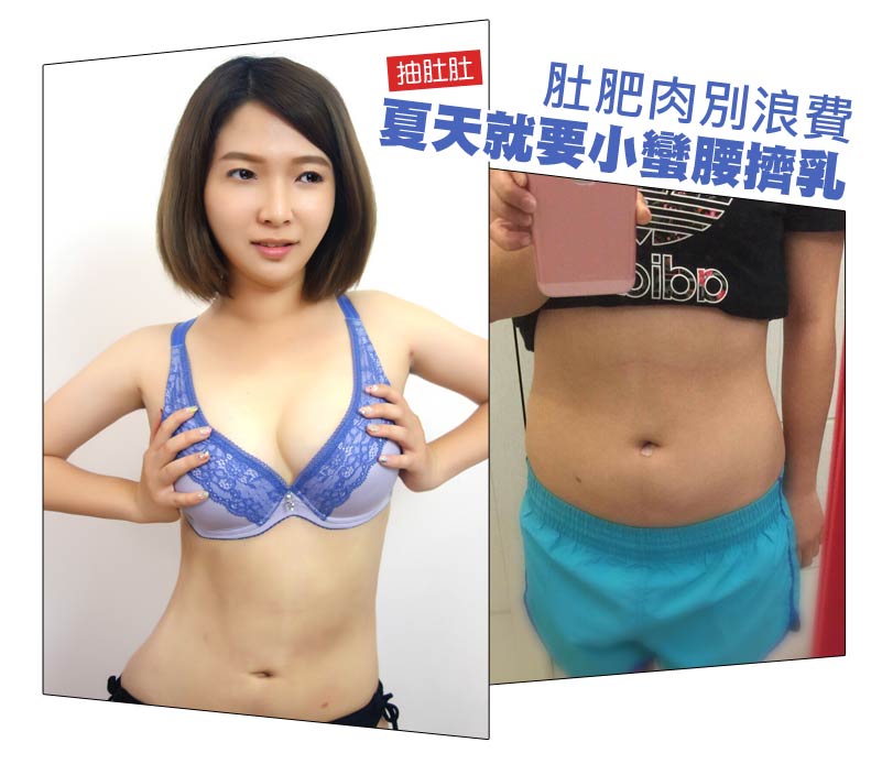 抽脂擠乳_經典案例