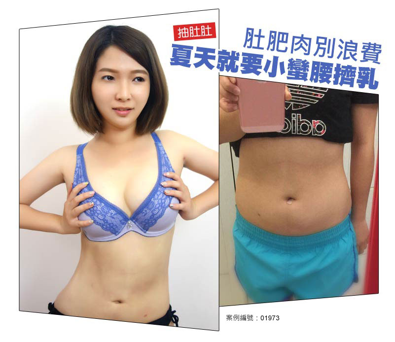 抽脂擠乳_經典案例