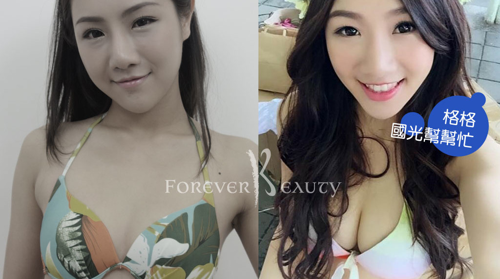 恆麗美型_蔡家碩_藝人抽脂隆乳案例_術前術後3