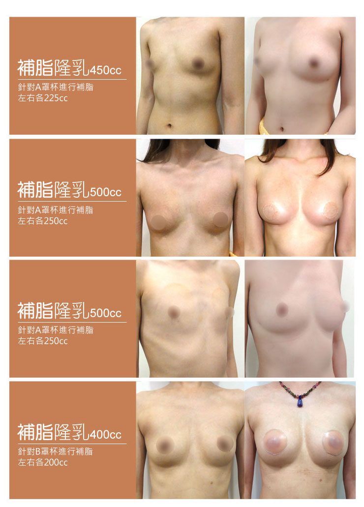 自體脂肪填補隆乳豐胸 案例