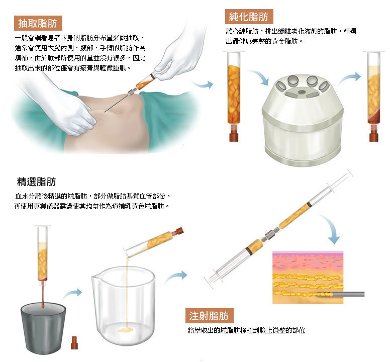 自體脂肪豐胸_2