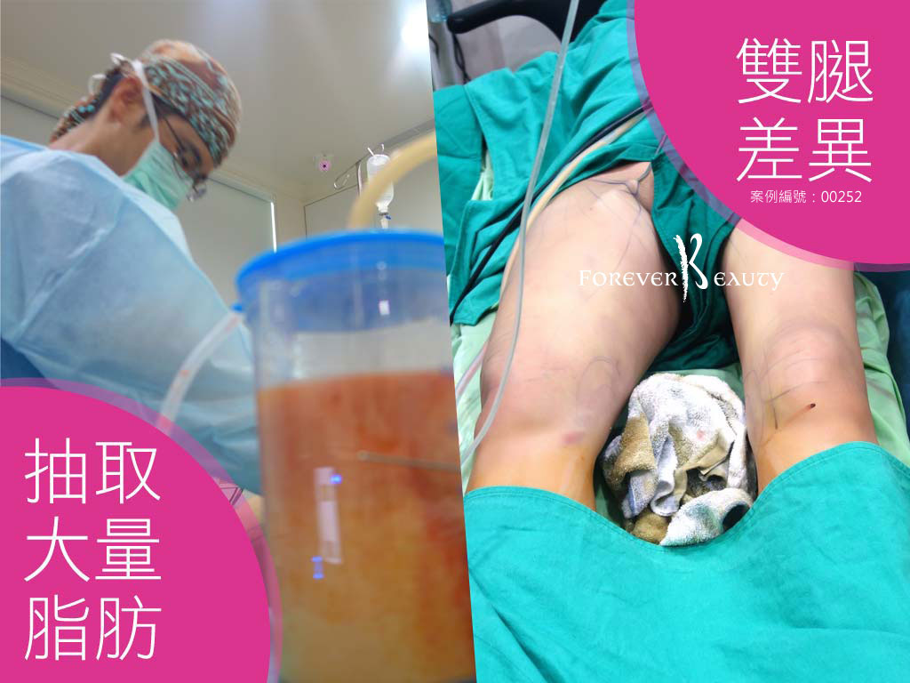 手術過程_抽取一半大腿差異