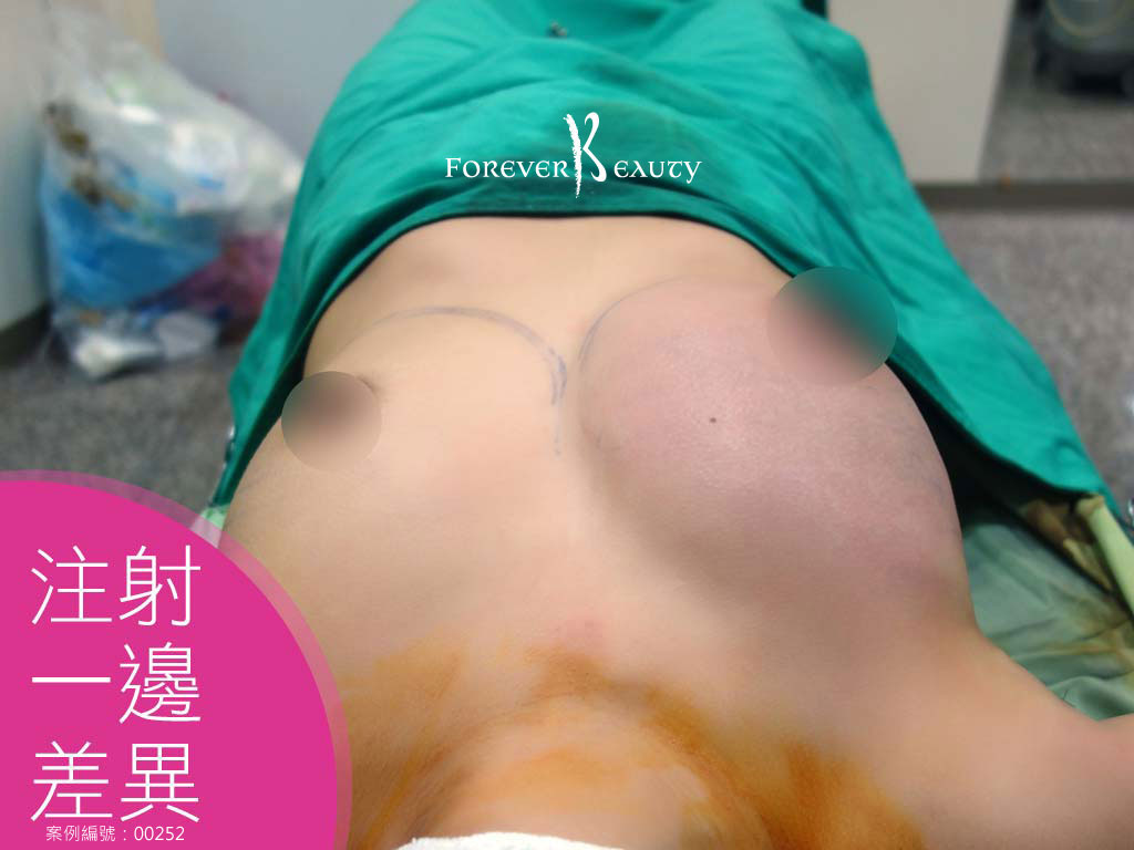 注射一邊差異_隆乳差異_蔡家碩