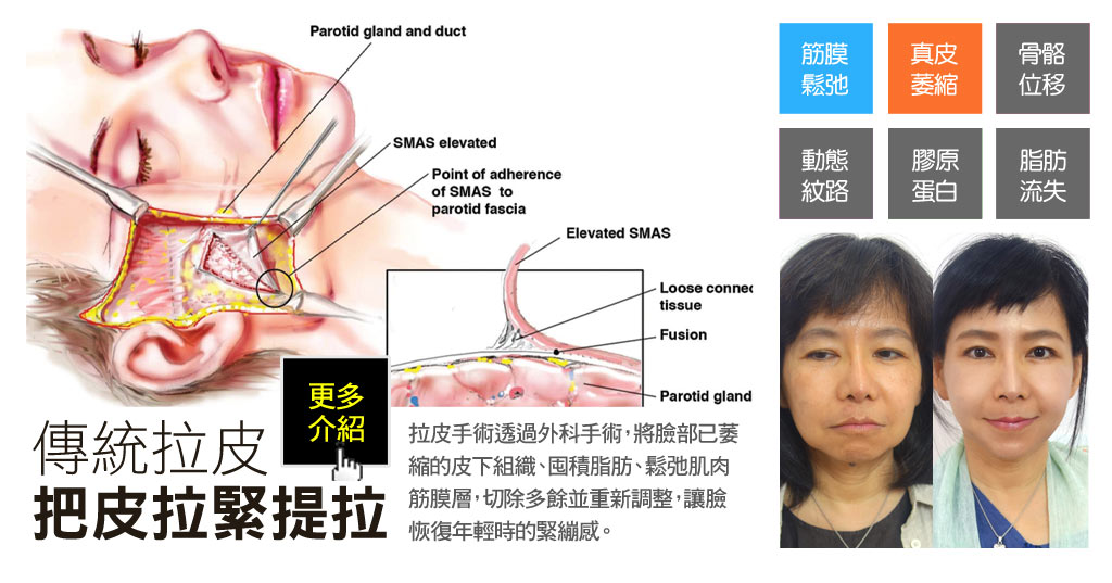 傳統筋膜拉皮