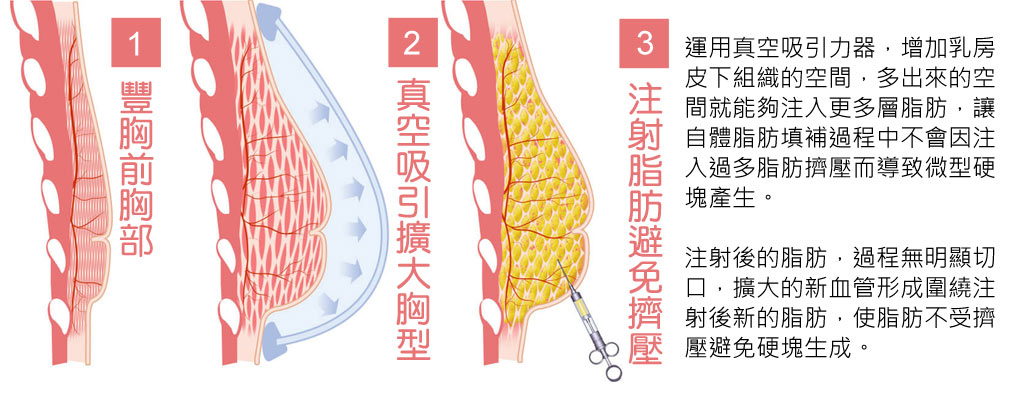 真空吸引胸部_自體脂肪隆乳風險_自體脂肪隆乳硬塊_隆乳SVF_美拉純脂袋_自體脂肪隆乳生長因子_自體脂肪隆乳PRP_自體脂肪隆乳存活率_恆麗美型_蔡家碩_隆乳推薦醫師