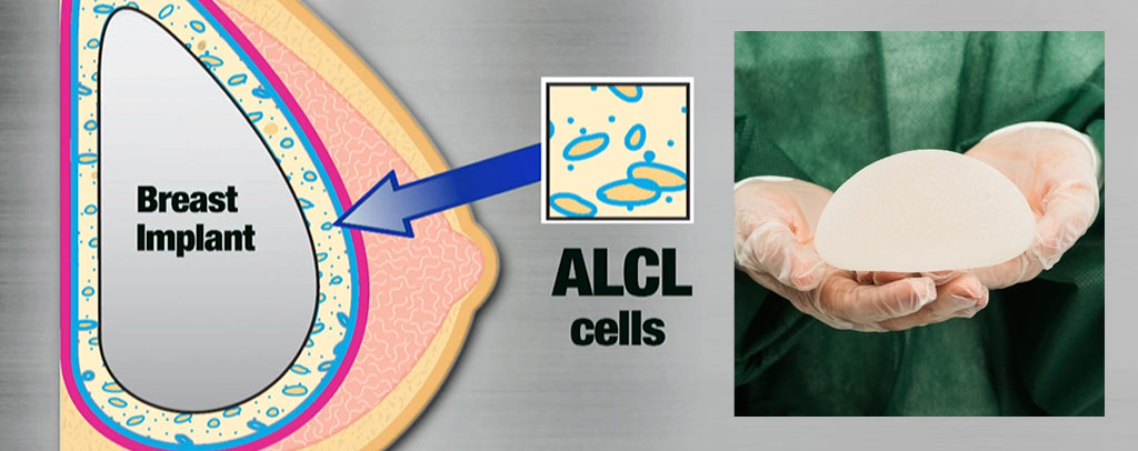 間變性大細胞淋巴瘤（ALCL）_果凍矽膠_乳房篩檢_乳房植物入致癌風險_果凍矽膠致癌_果凍矽膠癌症_隆乳癌症_隆乳失敗_隆乳後遺症_恆麗美型_蔡家碩