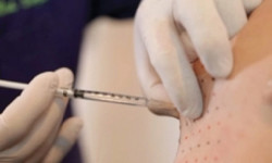 【微整形消脂針】倍克脂注射雙下巴與嘴邊肉真的很推薦,居然差這麼多!(4-13)