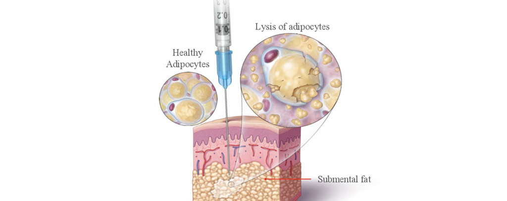 消脂針作用_Kybella_瘦臉針_溶脂針_消脂針推薦_雙下巴手術_恆麗美型_蔡家碩