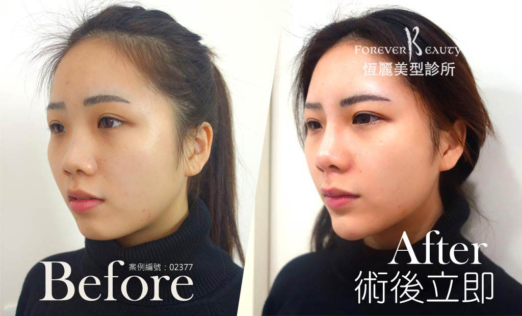 10日完美量微整鼻與下巴 完整影片收錄 恆麗整型醫美診所 自體脂肪隆乳 豐胸 減肥 微創抽脂 音波拉皮 隆鼻