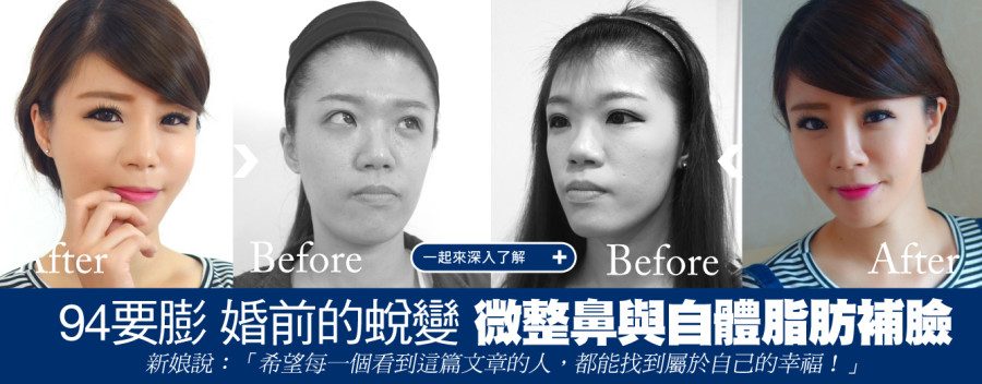 自體脂肪+微整量鼻