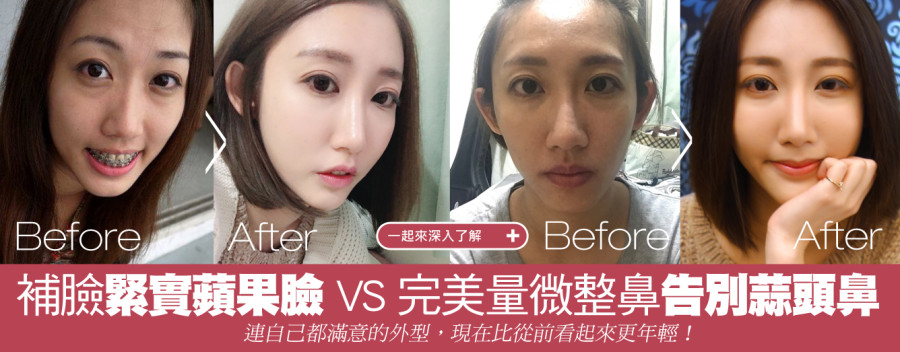 臉型重塑的完美 – 長臉人自帶桃花閃光