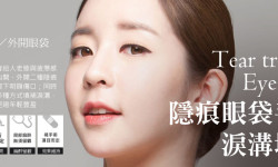 隱痕淚溝填補、內外開眼袋