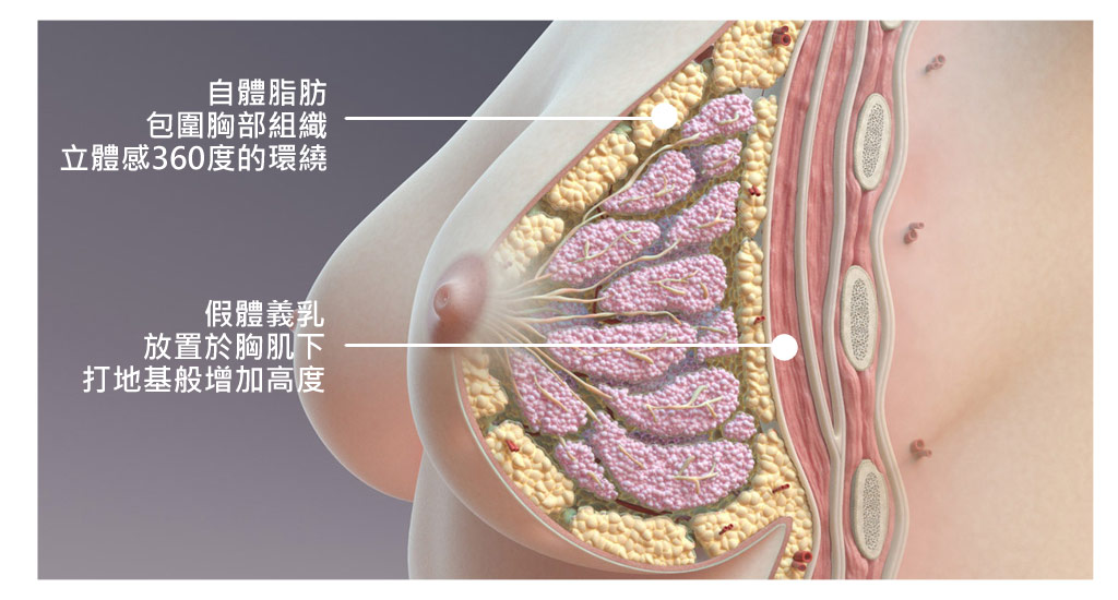 隆乳綜合比較_內容_假奶分辨_果凍矽膠隆乳_真奶假奶_自體脂肪隆乳_皮包球_矽膠假體_隆乳推薦_隆乳醫師_隆乳網路_重作隆乳_隆乳費用