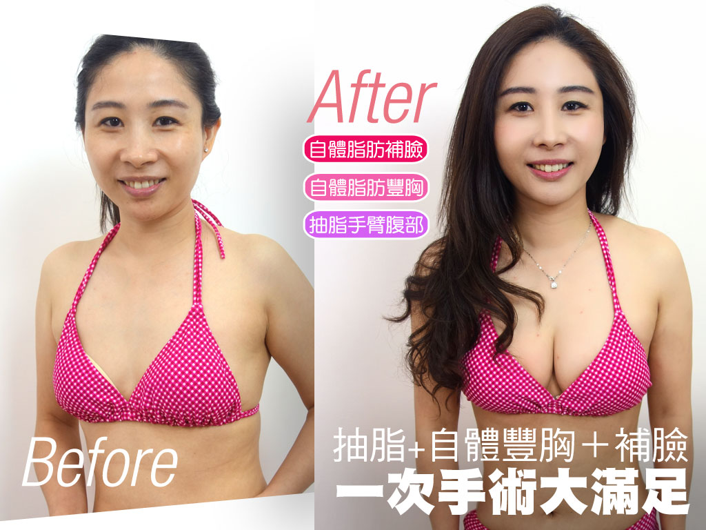 豐胸ptt 抽脂手臂作為自體脂肪豐胸與自體脂肪補臉 原來秘訣是 2 2 恆麗整型醫美診所 自體脂肪隆乳 豐胸 減肥 微創抽脂 音波拉皮 隆鼻