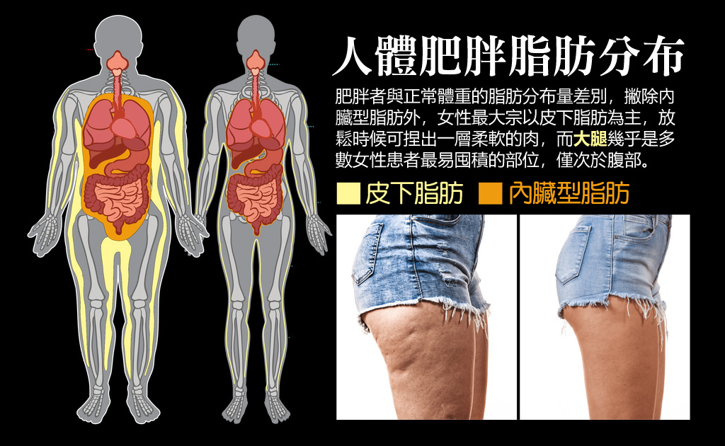 大腿抽脂_腿部抽脂_大腿環抽_下半身抽脂_大腿抽脂費用_大腿抽脂價格_大腿抽脂後遺症_大腿抽脂推薦_減肥大腿_恆麗美型_蔡家碩_大腿特輯_01