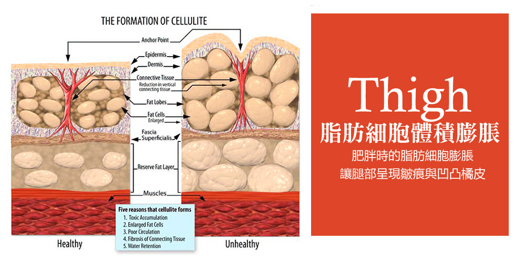 大腿抽脂_腿部抽脂_大腿環抽_下半身抽脂_大腿抽脂費用_大腿抽脂價格_大腿抽脂後遺症_大腿抽脂推薦_減肥大腿_恆麗美型_蔡家碩_大腿特輯_02