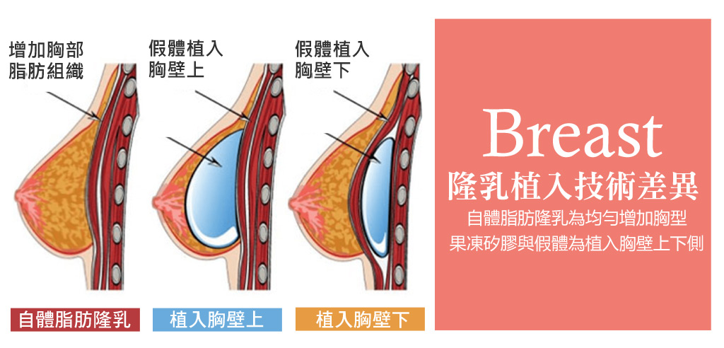 隆乳植入位置_隆乳手術_自體脂肪隆乳_自體脂肪豐胸_假體隆乳_自體隆乳_隆乳注意_隆乳推薦醫師_胸部特輯_02