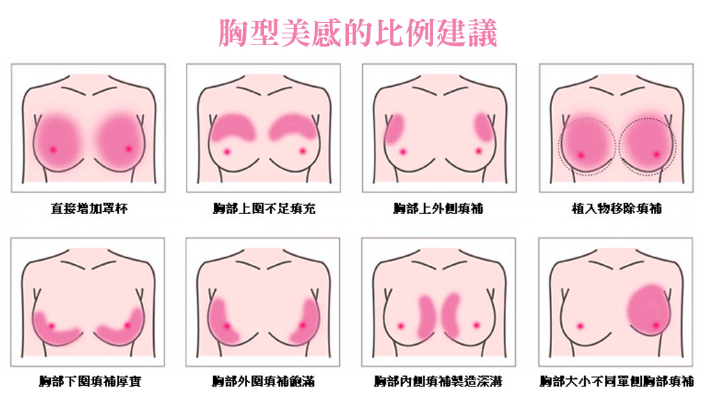 隆乳植入位置_隆乳手術_自體脂肪隆乳_自體脂肪豐胸_假體隆乳_自體隆乳_隆乳注意_隆乳推薦醫師_胸部特輯_03