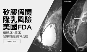 乳房植入物足夠安全嗎？美國FDA正式招開會議討論