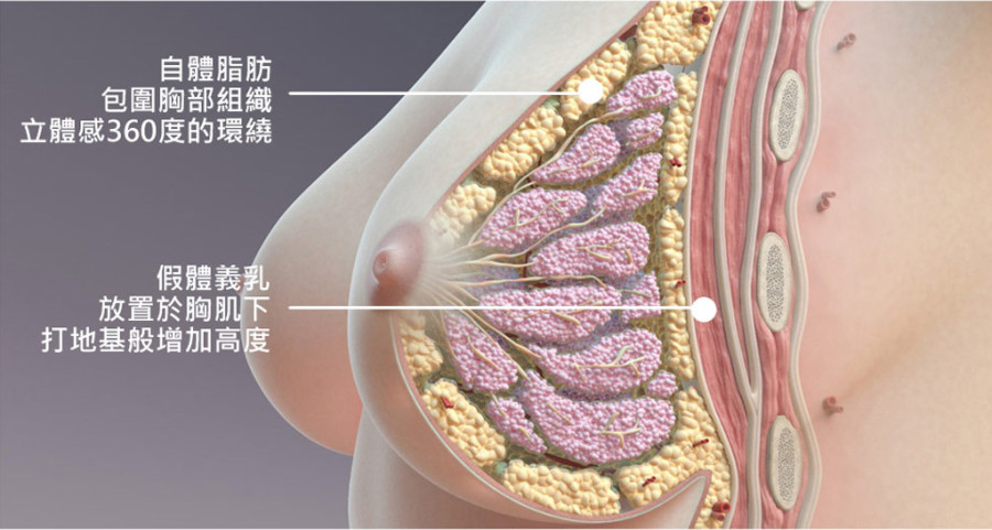 【隆乳後遺症】隆乳植入物夠安全嗎？美國FDA正式招開會議討論 (1-2)