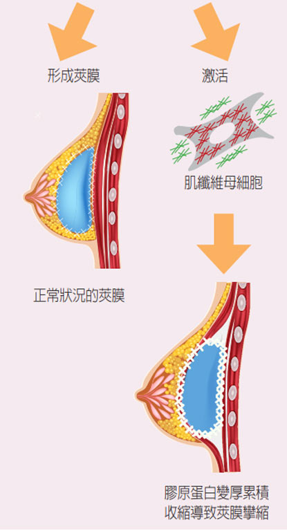 什麼是夾膜攣縮