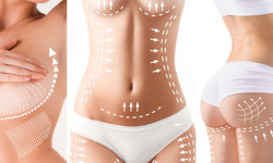 【抽脂費用】各種抽脂手術價錢費用大公開，音波溶脂、水刀抽脂、動力抽脂、微粹脂等費用 (3-1)