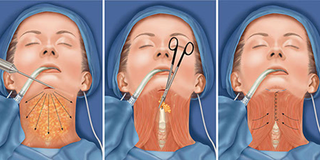 雙下巴抽脂手術過程