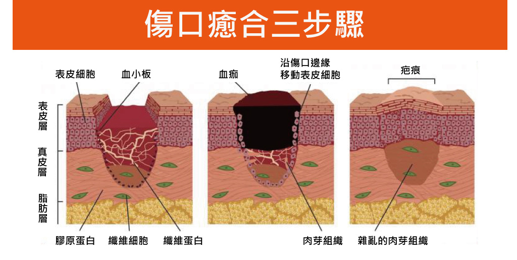 抽脂恢復_腫脹液_抽脂打水_水刀抽脂恢復期_抽脂術後發炎_抽脂術後燙傷_抽脂術後推薦塑身衣_03